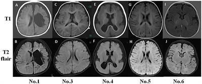 Different Frequency Bands in Various Regions of the Brain Play Different Roles in the Onset and Wake-Sleep Stages of Infantile Spasms